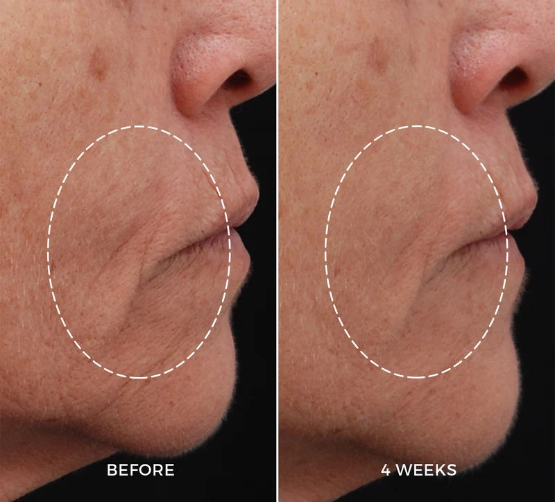 NEWA RF skin tightening device results