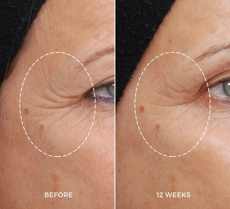 NEWA RF skin tightening device results