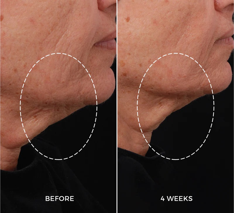 NEWA RF skin tightening device results