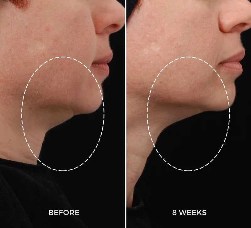 NEWA RF skin tightening device results